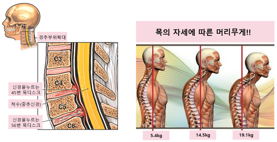 목 디스크